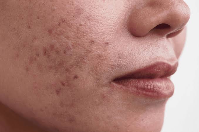 Hyperpigmentation