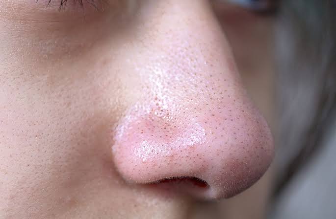 Blackheads